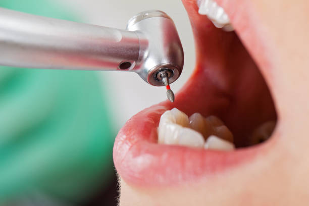 Best Emergency Dentist for Lost Fillings or Crowns in Mays Chapel, MD